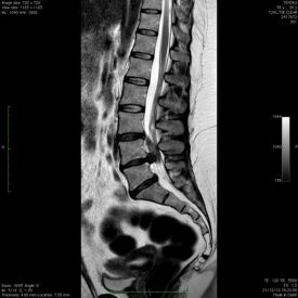 Hernia Discal Lumbar Causas y tratamiento Neurocirugía Barcelona