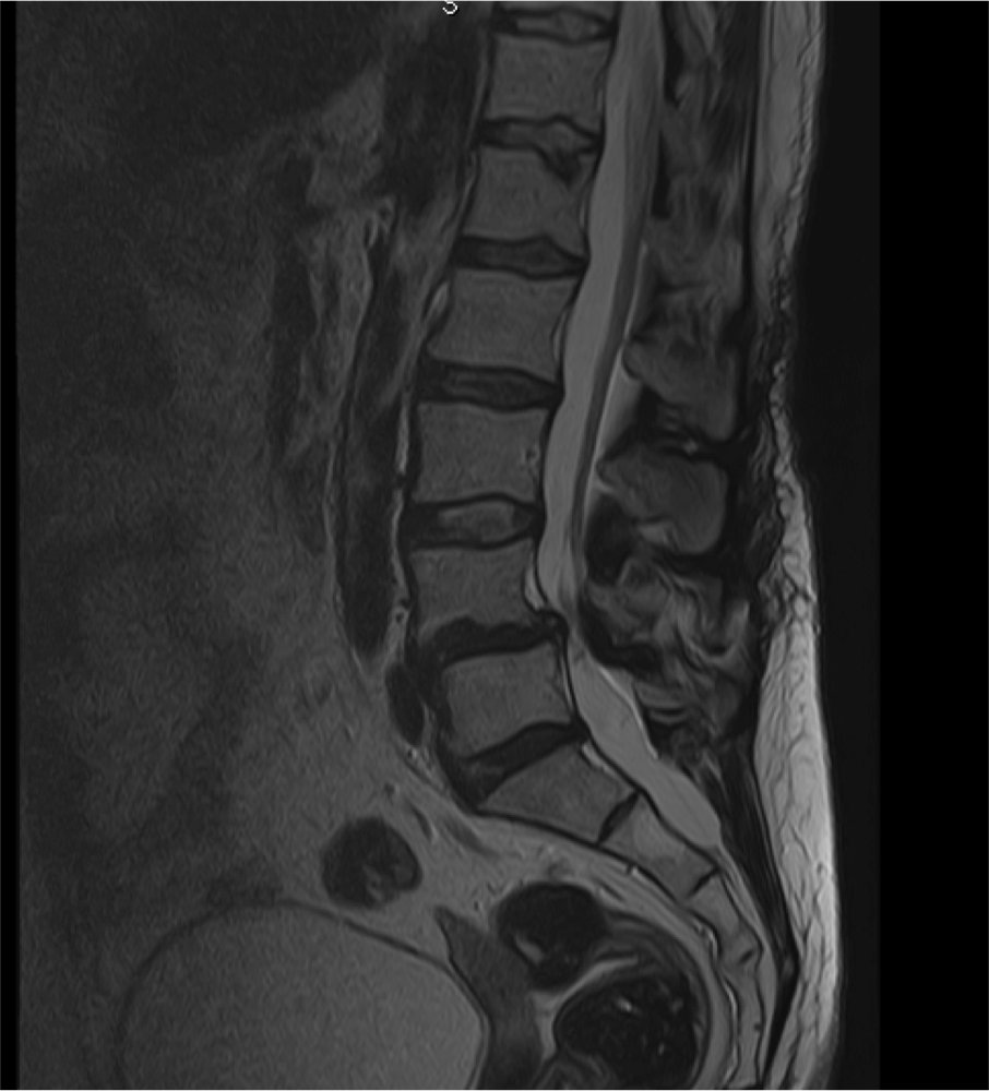 patología de columna estenosis de canal lumbar neurocirugía barcelona