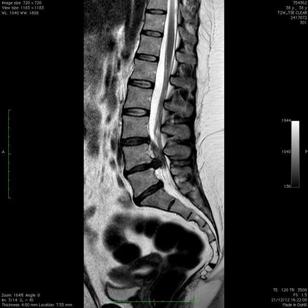 https://www.neurocirugiabarcelona.com/wp-content/uploads/2016/06/hernia-discal-lumbar.jpg